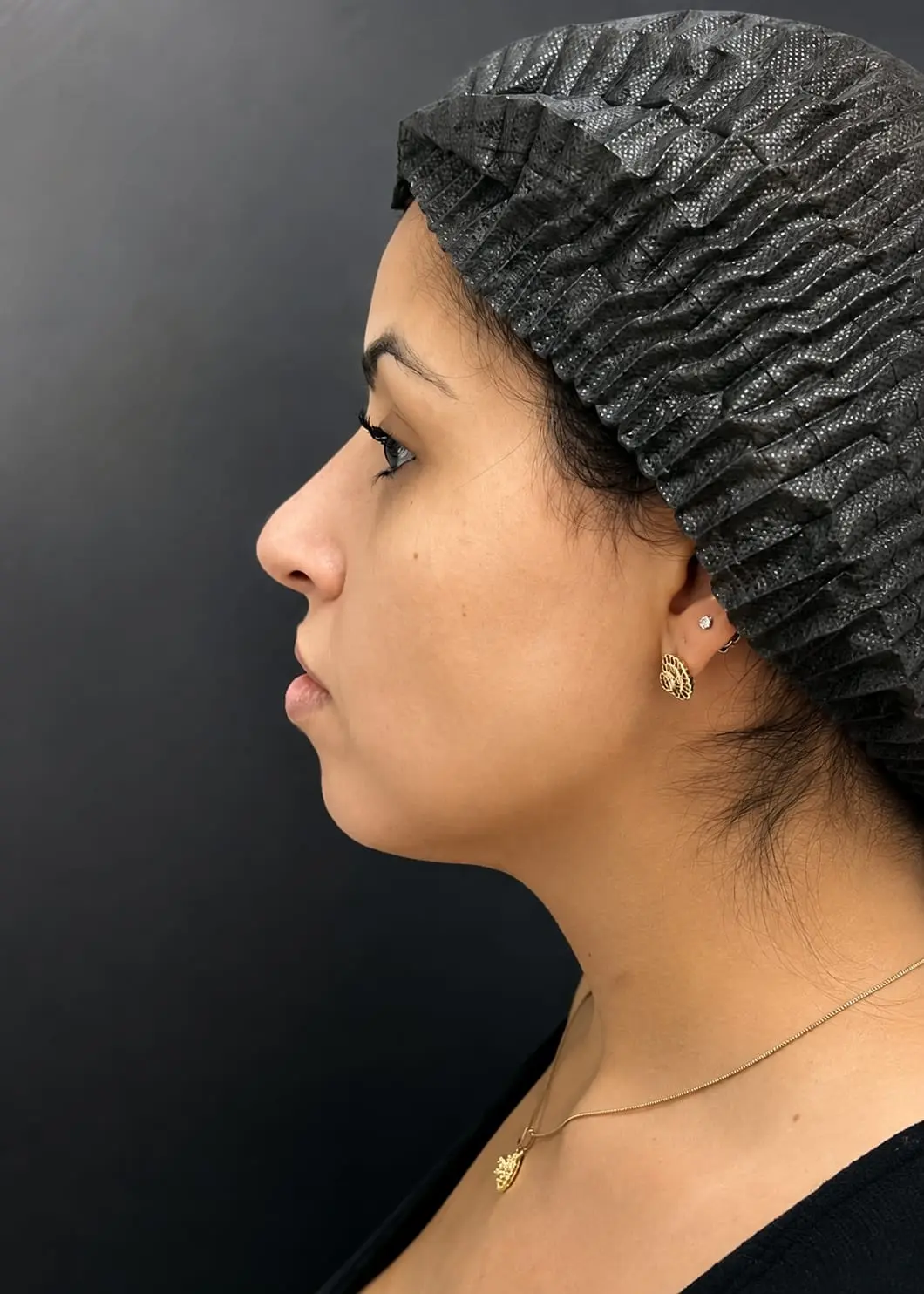 Perfil facial — antes